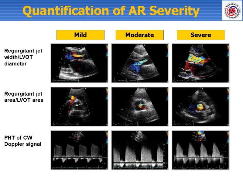 Mild Moderate Severe Regurgitant jet width/LVOT diameter Regurgitant jet area/LVOT area PHT of CW